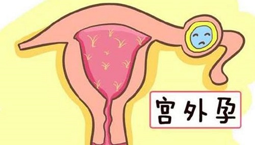 试管婴儿能有宫外孕吗？试管是否容易宫外孕？